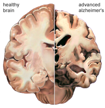Doenças Raras Quase Sem Cura Mal De Alzheimer