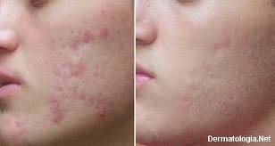 Asepxia Brasil Contra Acne E Espinhas