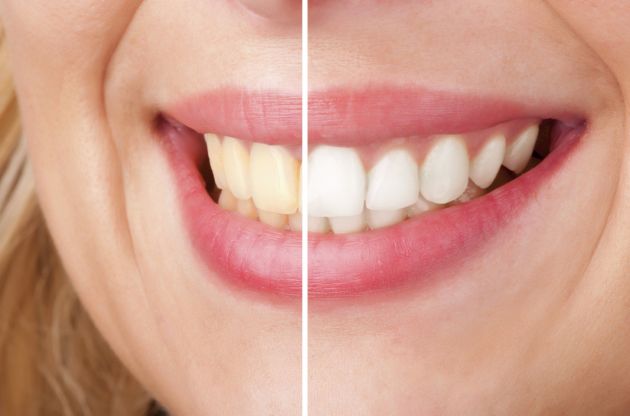  Clareamento dos Dentes com Óleos Vegetais   Como Fazer e Dicas clareara